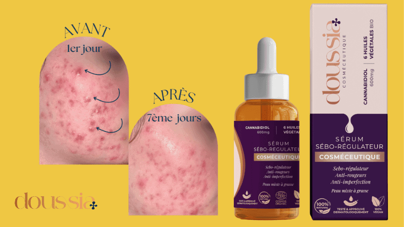 CBD et ACNE temoignages